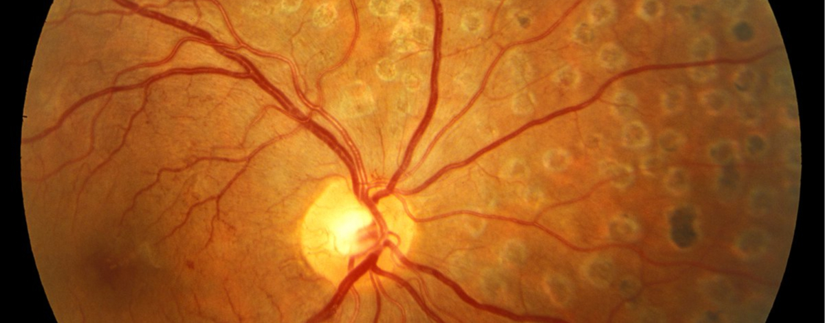 trattamento laser e membrana epiretinica