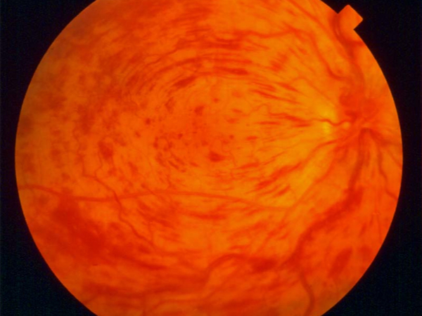 occlusione della vena centrale retinica