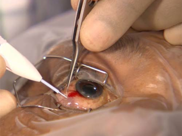 iniezione intravitreale di cortisone per la occlusione venosa retinica