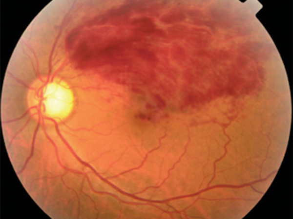 esame del fondo oculare in occlusione venosa di branca