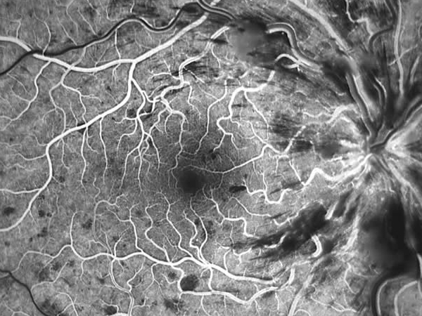 esame fluorangiografico della retina in occlusione venosa retinica