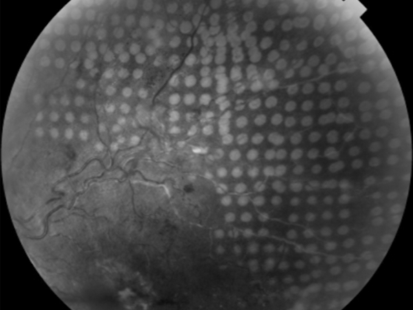 trattamento laser di occlusione venosa retinica