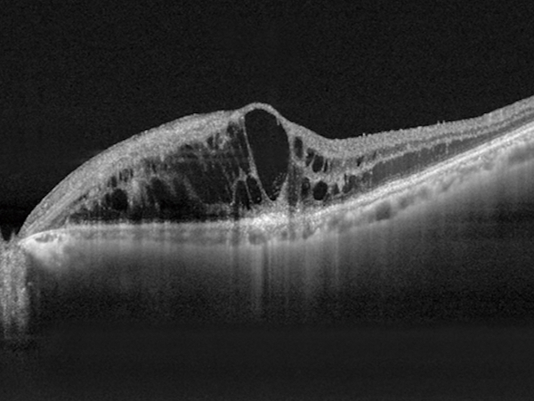 edema maculare cistico in oct
