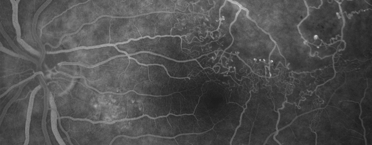 esame fluorangiografico in occlusione venosa di branca