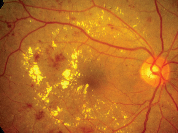 retinopatia diabetica non proliferativa