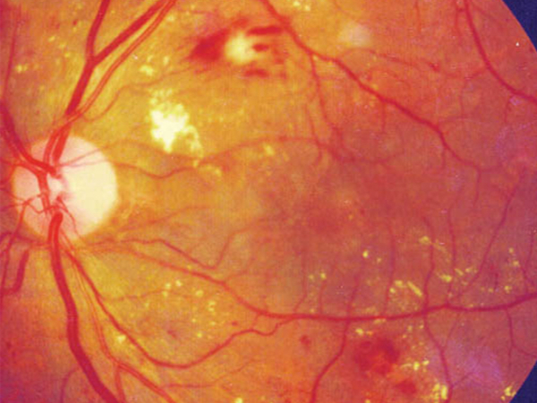 fondo oculare in retinopatia diabetica