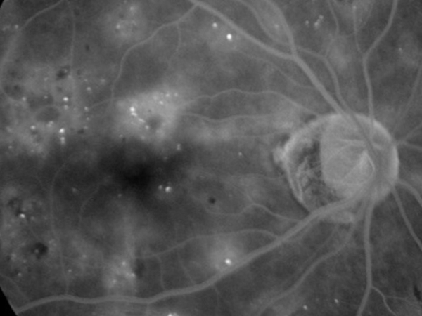 fluorangiografia retinica in retinopatia diabetica