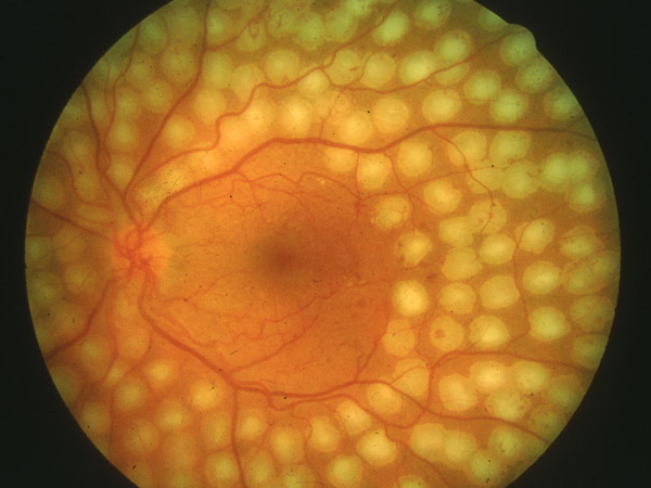 trattamento laser panretinico