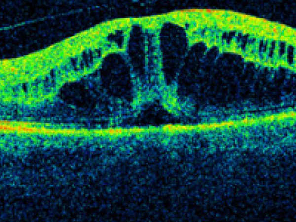 edema maculare diabetico in oct