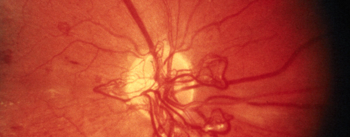 neovascolarizzaione della papilla ottica in retinopatia diabetica proliferativa