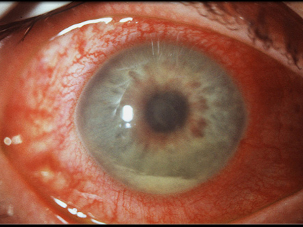 unveite anteiore con ipopion