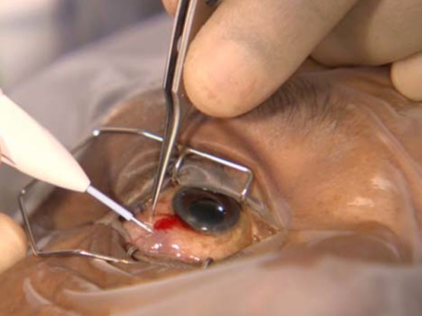 trattamento con cortisone in uveite