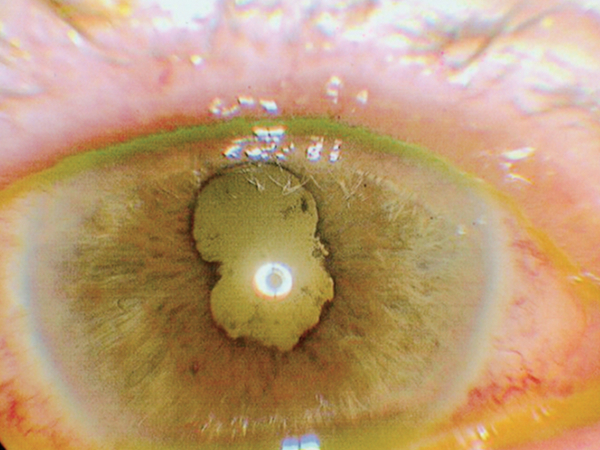 cataratta in uveite anteriore