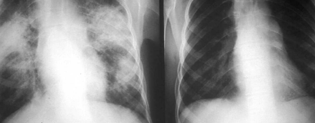 rediografia del torace