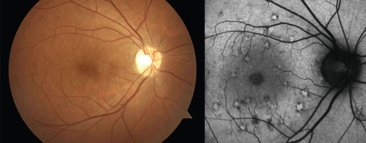 nveite posteriore con interessamento della retina